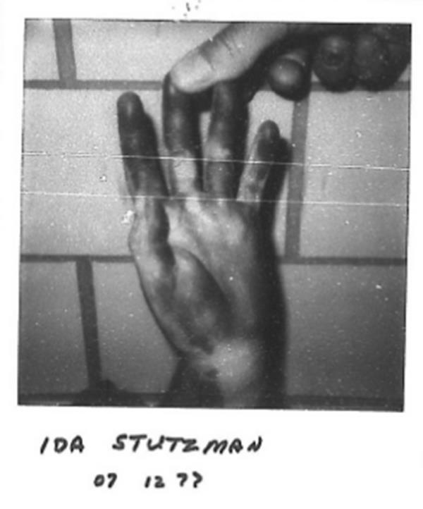 Black and white crime scene photos of Ida Stutzman's hand.