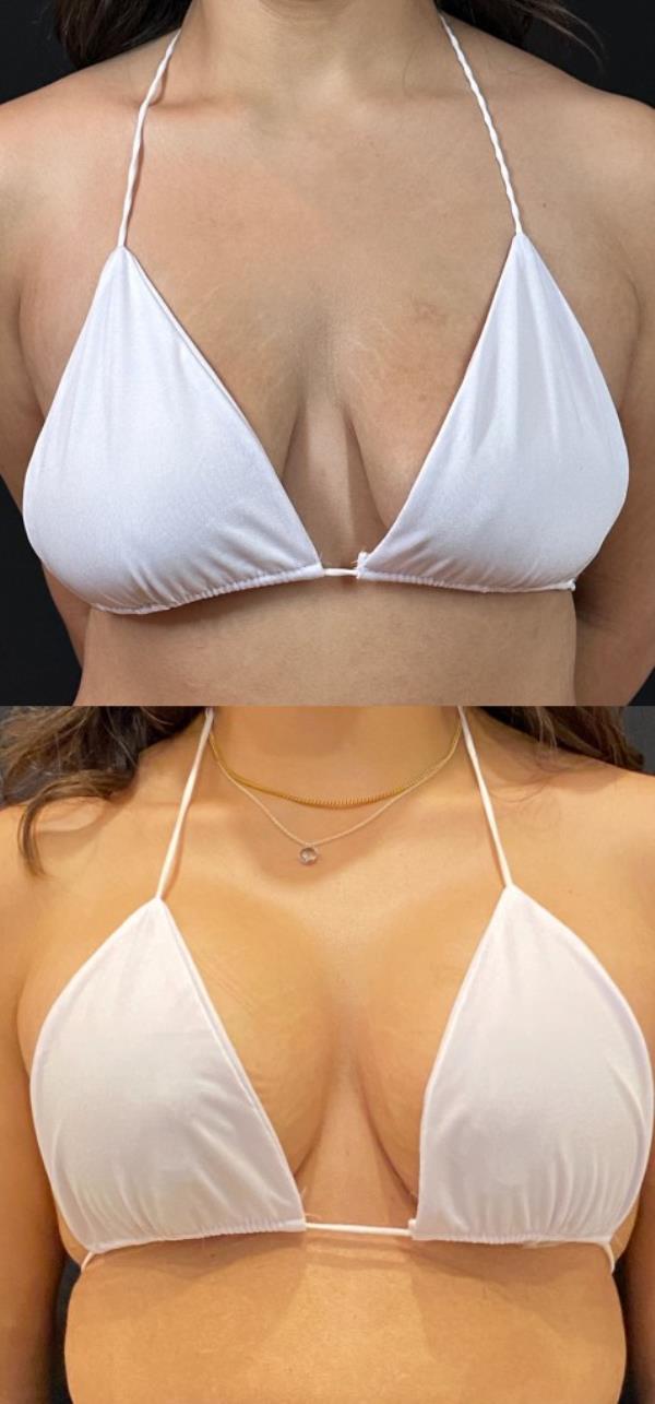 Before and After shots of Dr. Anna Steve's recent breast augmentation patient. 