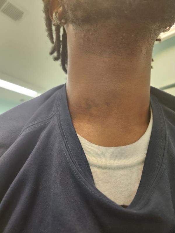 Photos of bruising on Jordan Williams’ neck from the struggle he had with homeless guy.