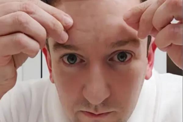 Dermatologist Scott Walter put tape on his face overnight to check for the presence of Demodex.