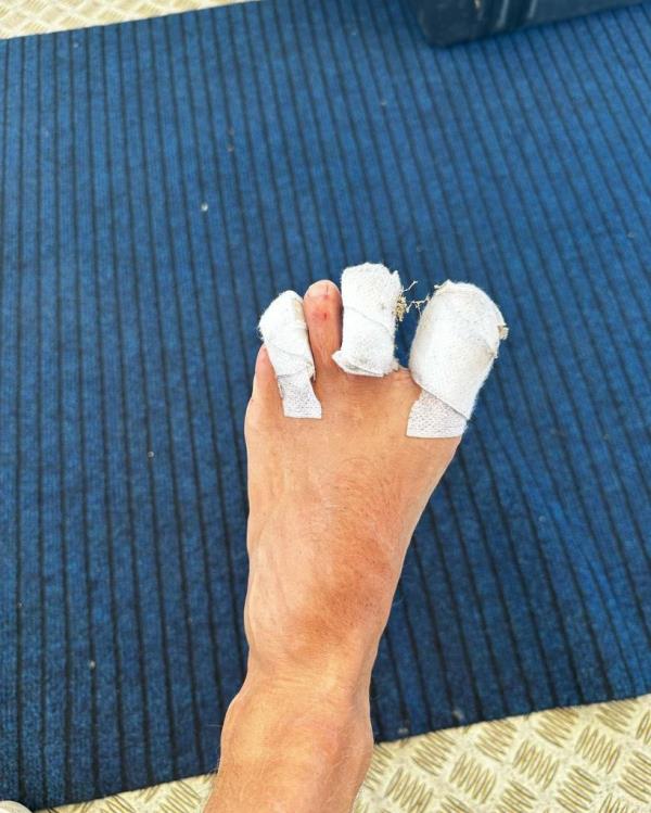 Colin Jost's foot injury